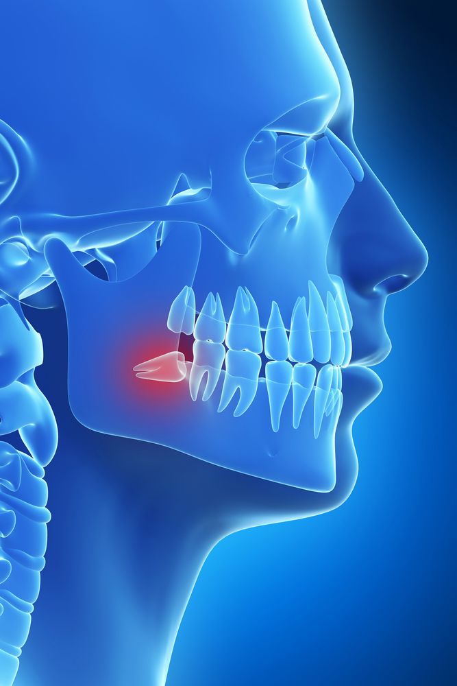 illustration of impacted wisdom tooth
