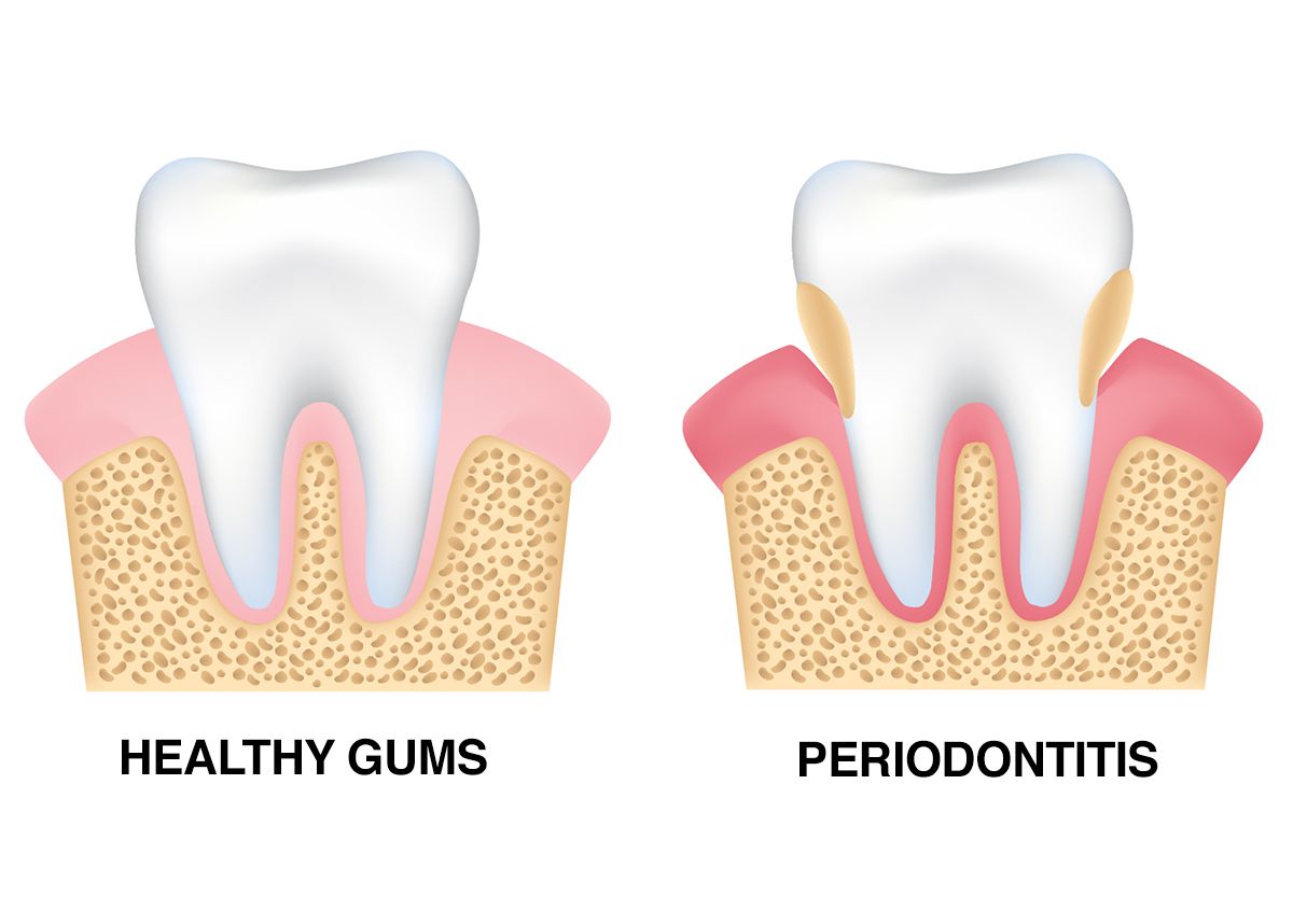 Diagram showing healthy tooth and tooth suffering from periodontitis