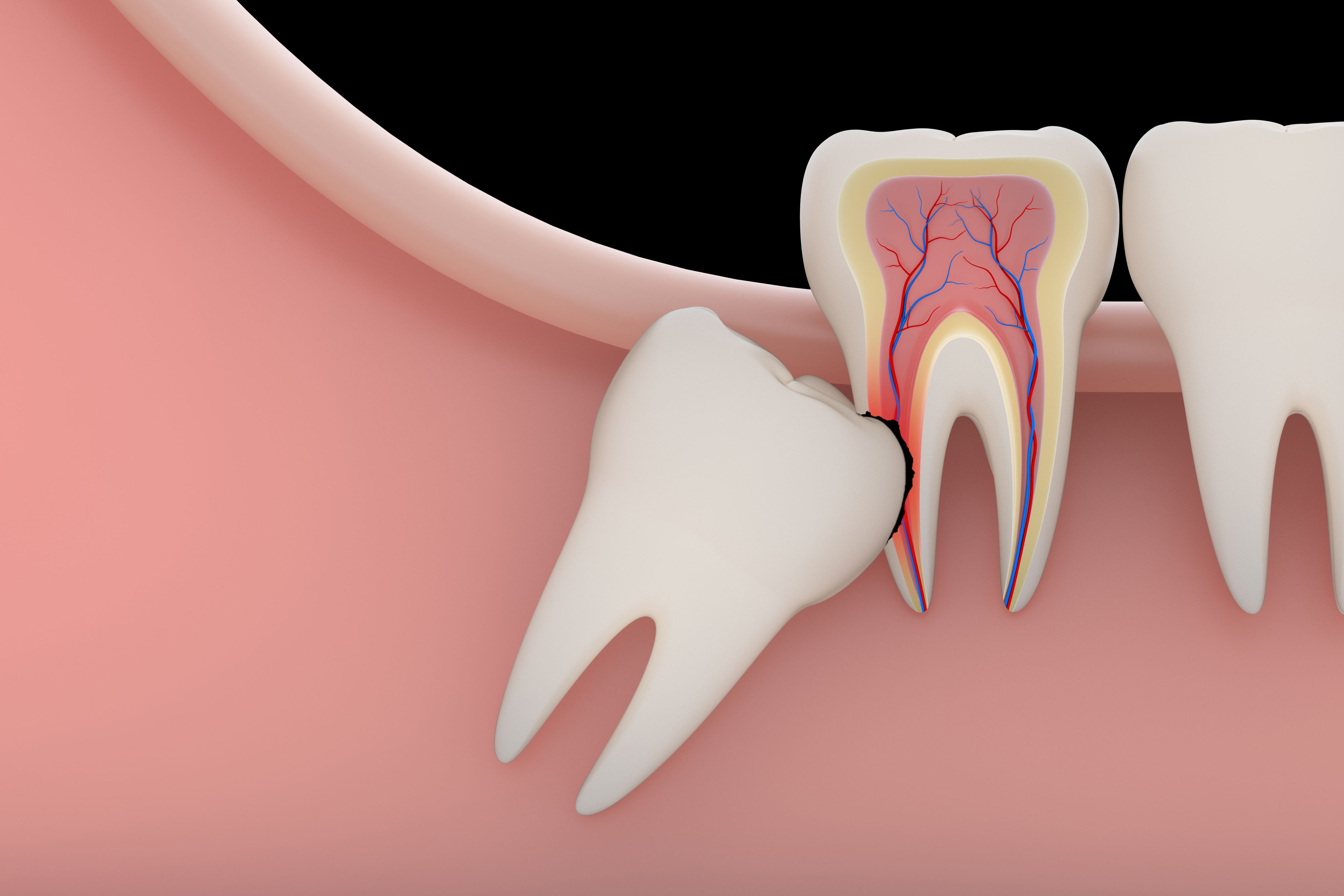 Image of impacted wisdom tooth