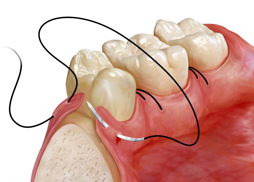 sutures in gums