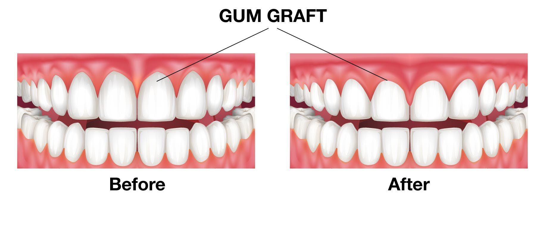 Teeth before and after gum graft