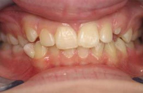 A patients crooked teeth before braces