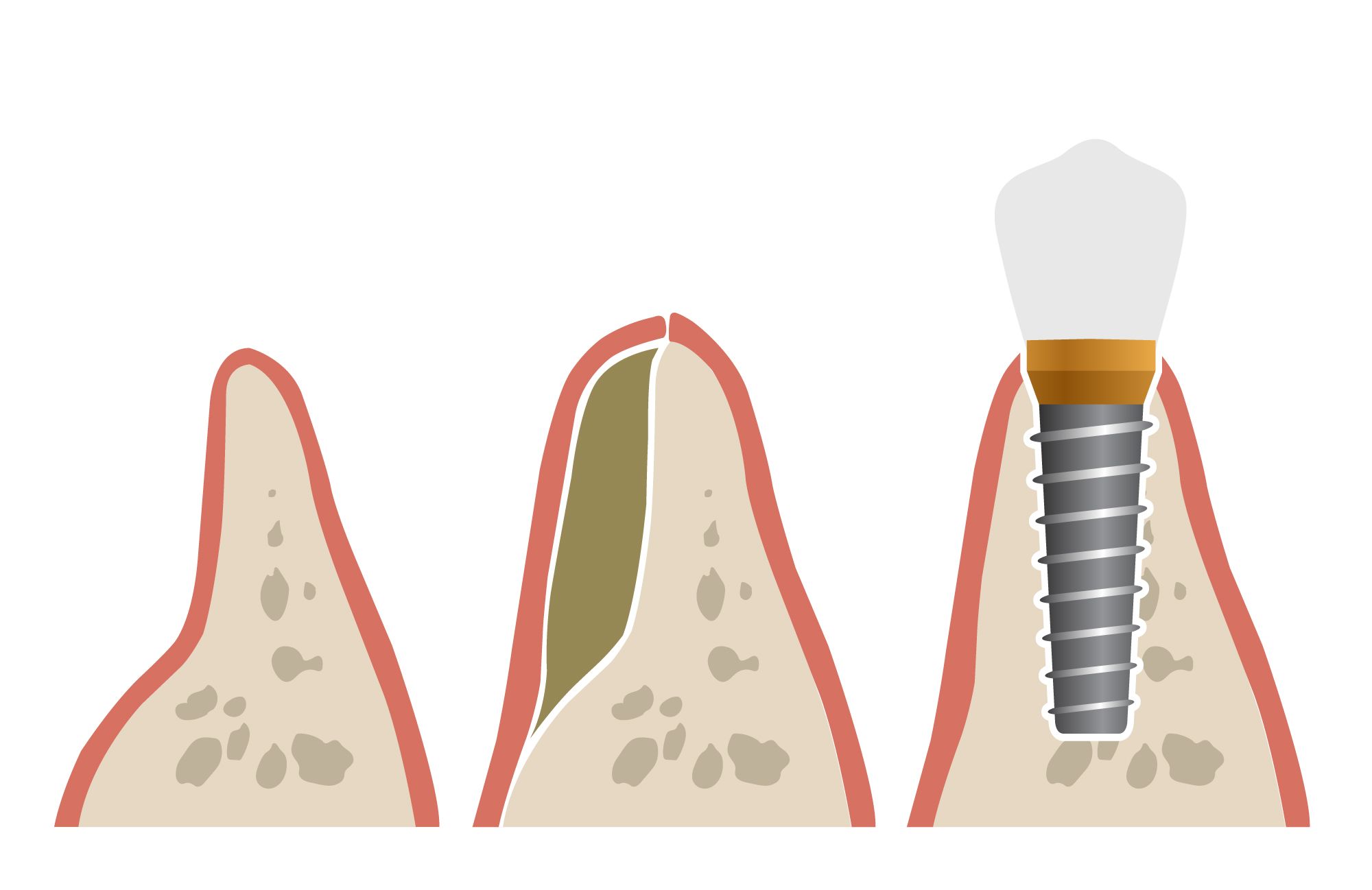 Image of bone deterioration, bone grafting, and implant-supported prosthesis