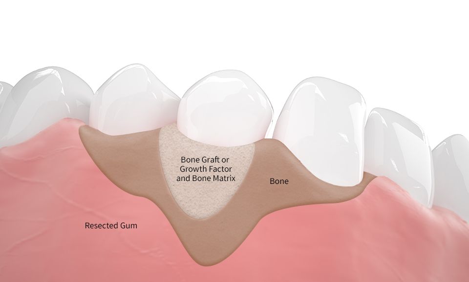 Side by side images of healthy tooth and diseased tooth