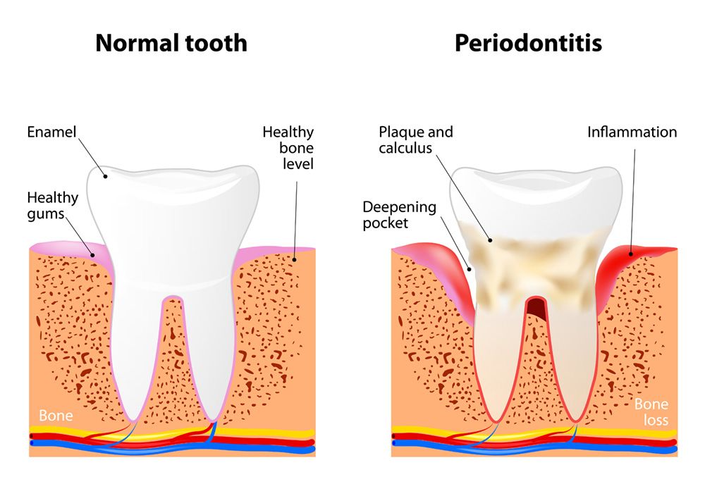 Illustration of healthy tooth versus gum disease